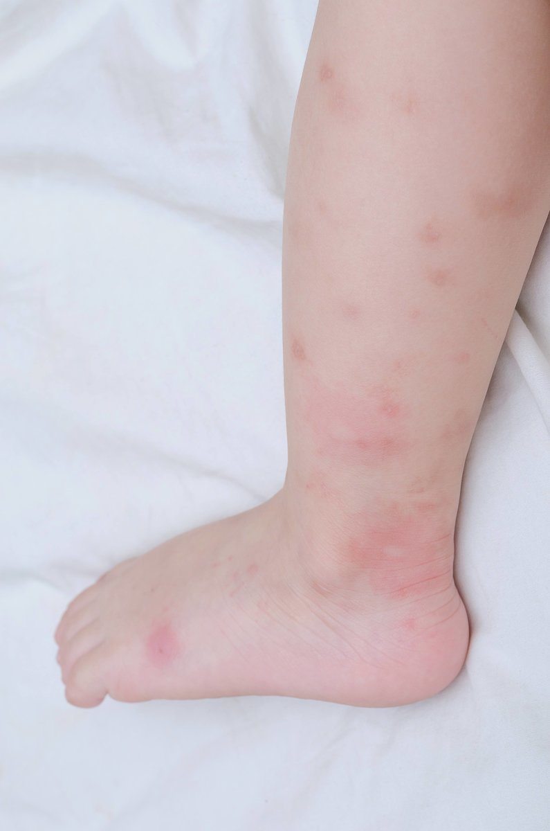 Mosquito Bites Sore On Baby Legs