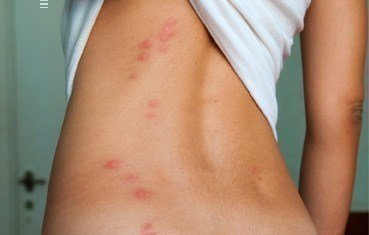 woman with bed bug bites