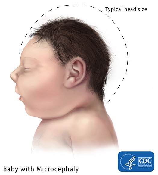 microcephaly