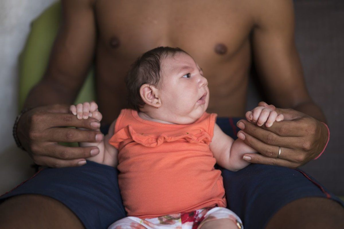 microcephaly